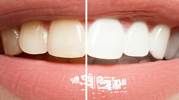 Formation-Blanchiment-dentaire