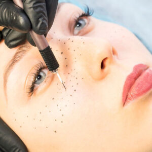 Formation dermopigmentation tâches de rousseur & grains de beauté