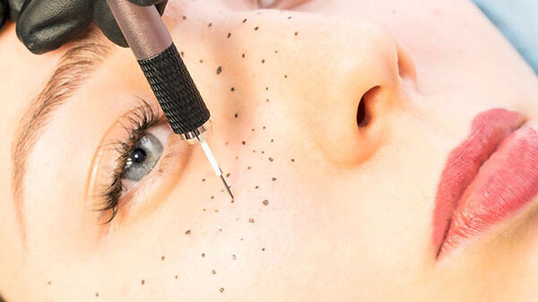 Formation dermopigmentation tâches de rousseur & grains de beauté