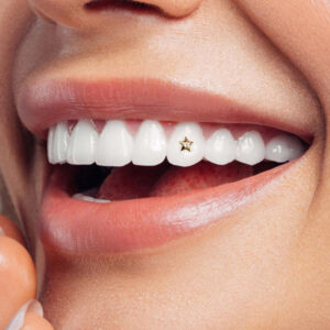 Formation Pose de Bijoux Dentaires